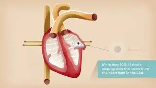 Understanding the WATCHMAN&trade; Procedure