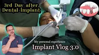 Dental Implant गरेको तेश्रो दिनको अनुभव / Done By &lrm;@kkhagendra&nbsp;|| Sun City Dental Clinic