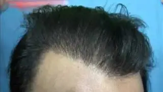 KH - 4100 + FUHT   grafts ( 9 months update )