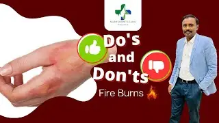 Do&rsquo;s and Dont&rsquo;s on Fire Burns | Cracker Burns | First Aid