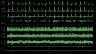 ECG intracardiaque avec son de la dadabase Intracardiac Atrial Fibrillation (Physionet) iaf6_ivcm