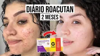 2 MESES COM ROACUTAN - Efeitos colaterais, produtos que tô usando e mais | por Jessica Melo