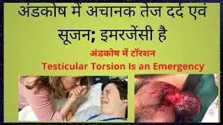 Testicular Torsion, Testicular Pain and Swelling,पुरुष अंडकोष में दर्द.(Prof)Santosh Kumar PGI