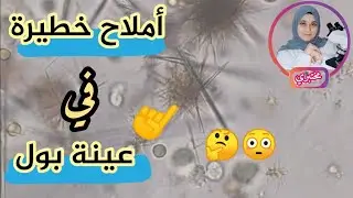 فحص عينة بول تحت المجهر والفرق بين الاملاح الكريستاليه tyrosine & ammonium biurate crystals