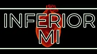 Inferior MI
