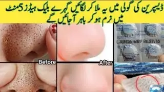 How To Remove BLACKHEADS Permanently From Nose & Face Instantly 100| Naturally At Home No Whiteheads