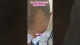 Shedding phase! Be assured, is completely normal. It is expected some hairs shed after a transplant.
