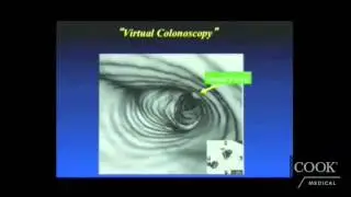 Colon Cancer Early Detection