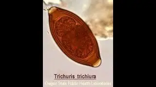 Trichuris trichura or whip worm egg