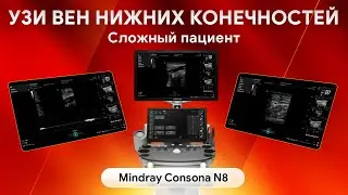 УЗИ вен нижних конечностей при ожирении: возможности Mindray Consona N8