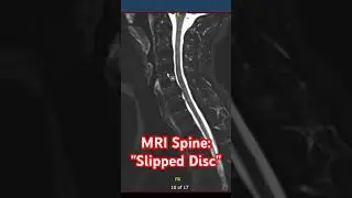MS and a Slipped Disc? 😭