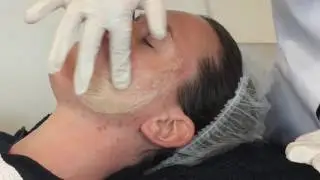 Medische peeling(mesoestetic) voor Acne van Cosmetic Team