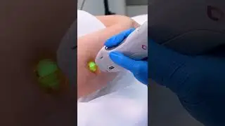Laser Hair Removal in Dubai | Smooth, Safe & Effective Results