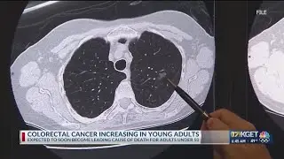 Colorectal Cancer cases increasing amongst adults under 50