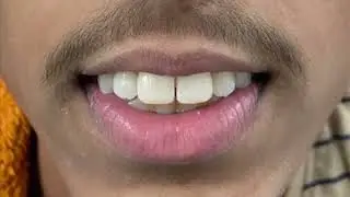 Long teeth to short teeth : Reshaping of Enamel &hellip;&hellip;. Happy patient 😊😊