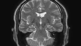 MRI brain scans