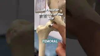 HOW DO YOU GET BONE NECROSIS OF THE HIP?