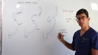 What is the Modified Duodenal Switch Procedure? - Dr. Mario del Pino