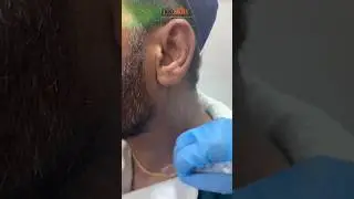 Neck Pigmentation -  Expert Skin Peel | Neoskin Madhapur | Love your skin