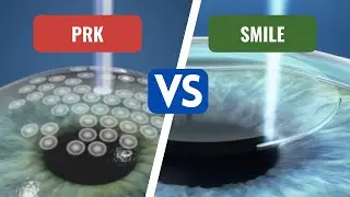 LASIK / SMILE / PRK - which is BEST? | Tamil | Dr. Syed Moosa | Eye Doctor |