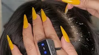 ✨ Tingly Hair Scalp Check ASMR | Detailed Dandruff Scratching #DN571