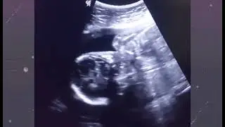 Fundoanterior placenta | Anterior placenta means baby boy! | Posterior placenta means baby girl!