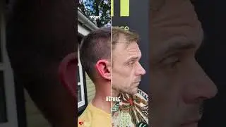 Hair Transplant Turkey Transformation 3, 6, 9 Months | MCAN Health