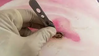ASMR Ear cleansing - MASSIVE EAR WAX REMOVAL RESTORES HEARING AFTER 86 YEARS--