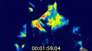 Infrared imaging of human adult brown fat