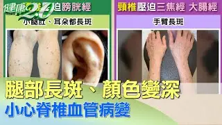 腿部長斑、顏色變深 小心脊椎血管病變 健康2.0