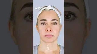 6-MONTH FACELIFT UPDATE 🤩 Dr. Johnson C. Lee | Beverly Hills, CA