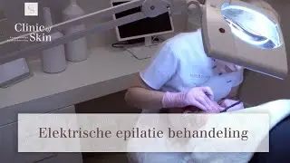 Elektrische epilatie behandeling