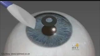 FDA Approved Corneal Implant Corrects Near Vision Loss