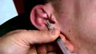 Perichondral Hematoma - YouTube.flv