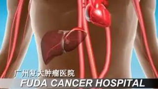 Cancer Microsphere Intervention of Fuda Cancer Hospital