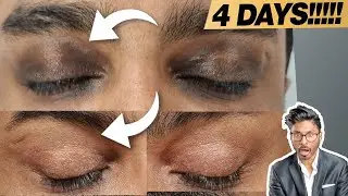 How To Get Rid Of Under Eye Dark Circles In 4 days WITHOUT Filler, Skincare…