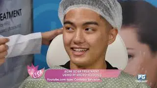 ACNE SCAR TREATMENT  USING RF MICRO NEEDLING