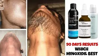 Best minoxidil for beard growth 2026 | 90 days beard growth results minoxidil | minoxidil beard |