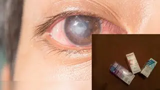 تجربتي مع بكتيريا إلتهاب القرنية العين من المعاناة للشفاء وأهم  القطرات Optibtipred_Navitae_Ciloxan