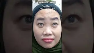 [Vellux] Premium botulinum toxin