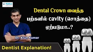 Will Cavities occur in Teeth with Dental Crowns..? | Pearls Dentistry | Chennai