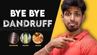 4 Easy Ways to Remove DANDRUFF Permanently (For Men & Woman)