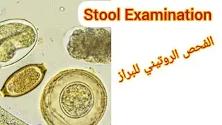 كيفية كتابة تقرير فحص البراز   Stool Examination Report