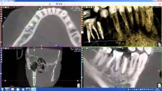Endo job made easy with Acteon Imaging software CBCT system by Acteon