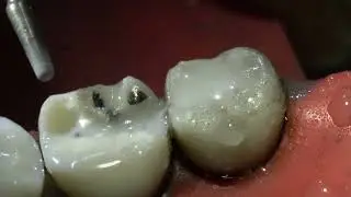 Non Retentive Ceramic / Emax Overalay / Table top Restoration Preparation