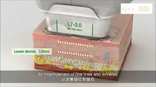 Dr Lau Chin Hoh on Ultraformer MPT #ultraformer #ultraformermpt #hifu #aestheticclinic