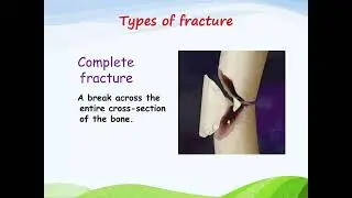Types of fracture#medicalshorts #medicalimaging #healthawareness #bonestructure #bones ##drdilfarakh
