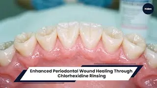 Enhanced Periodontal Wound Healing Through Chlorhexidine Rinsing: A Clinical Trial Investigation.