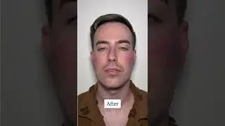 Male Facial Balancing! 🔥