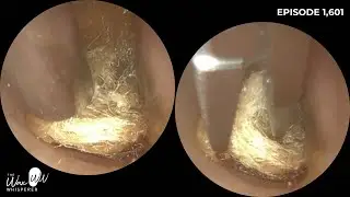 1,601 - EMERGENCY SUNDAY CLINIC! Watch me remove a cotton bud from my Aunty&rsquo;s ear!